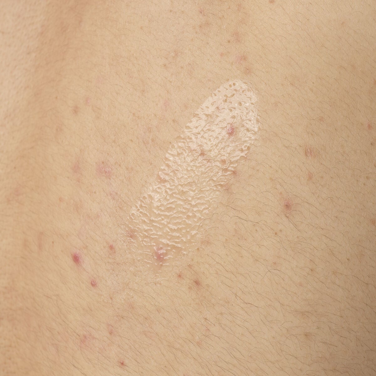 salicylic-acid-0-5-body-serum-s2 ORD-salicylic-acid-05-body-240ml-application.jpg