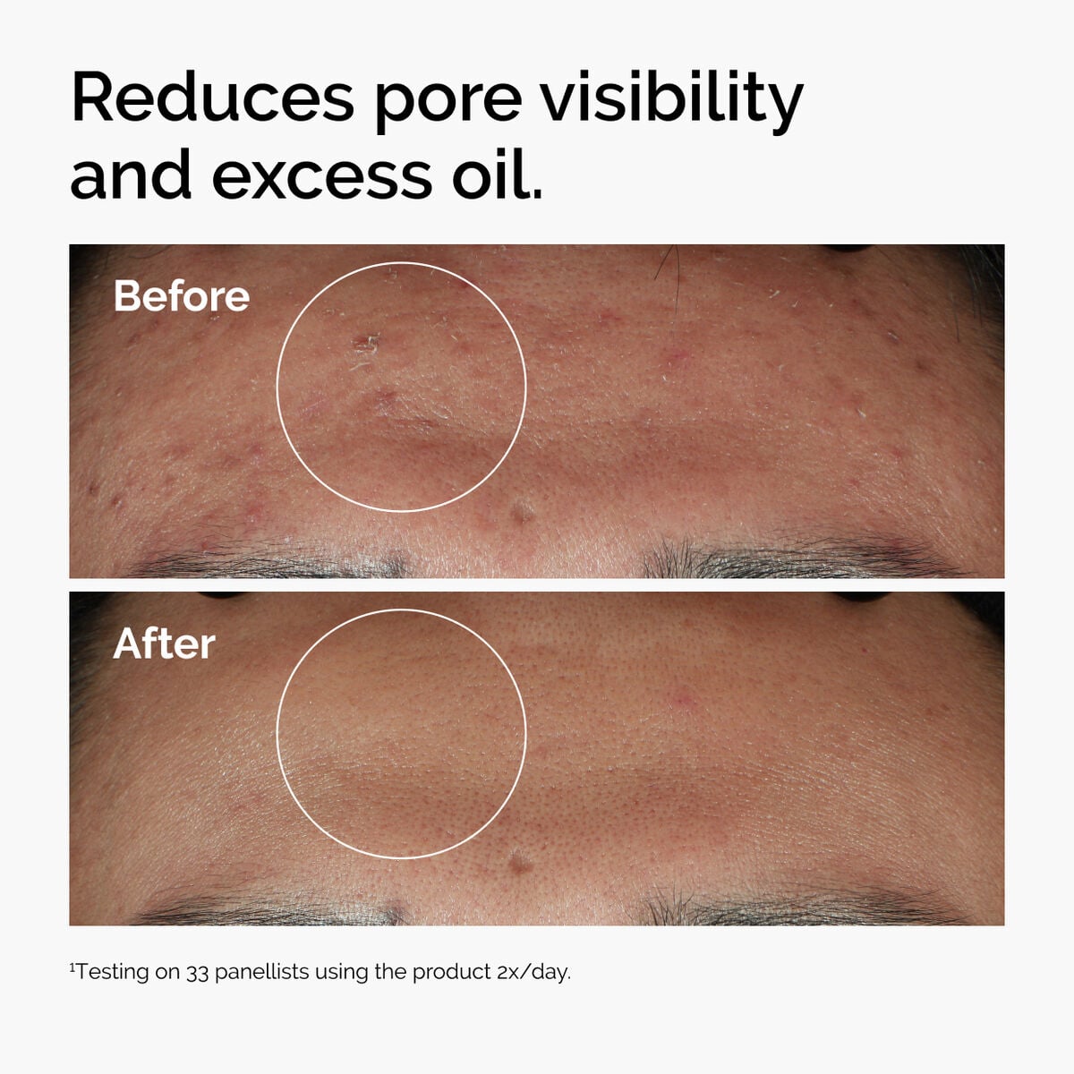 niacinamide-10-zinc-1-n8 ord-niacinamide-zinc-blemish-serum-before-after-pores.jpg