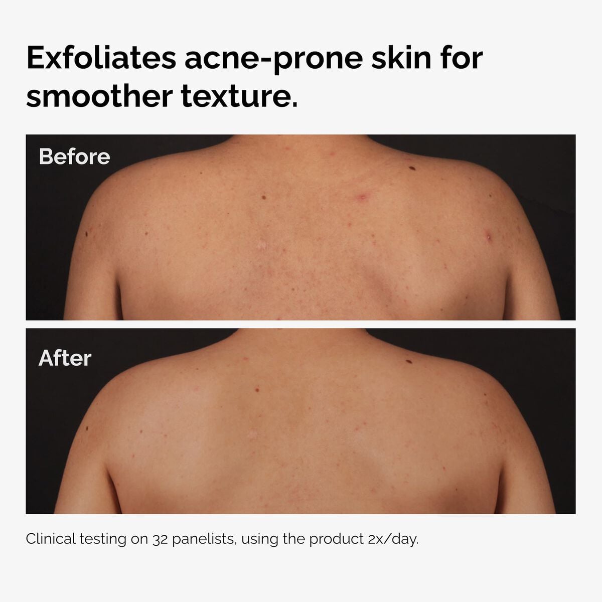 salicylic-acid-0-5-body-serum-s2 ord-salicylic-acid-body-serum-before-after-graphic-NA.jpg